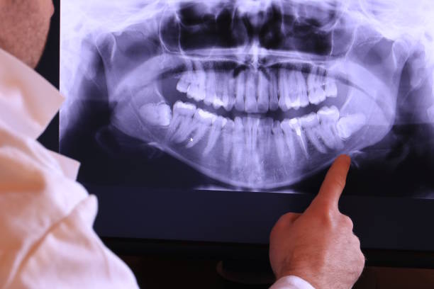 Best Emergency Wisdom Teeth Removal in Great Neck Estates, NY
